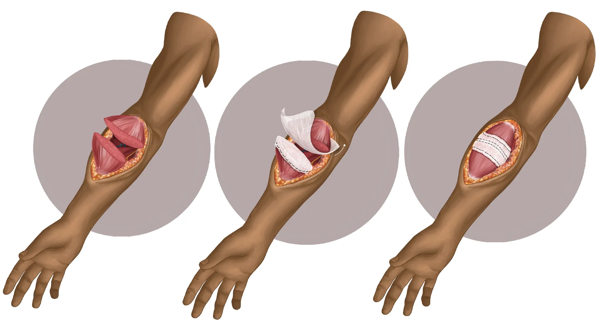 Medical illustration: three stages of the SMART technique applied to a transected forearm muscle.