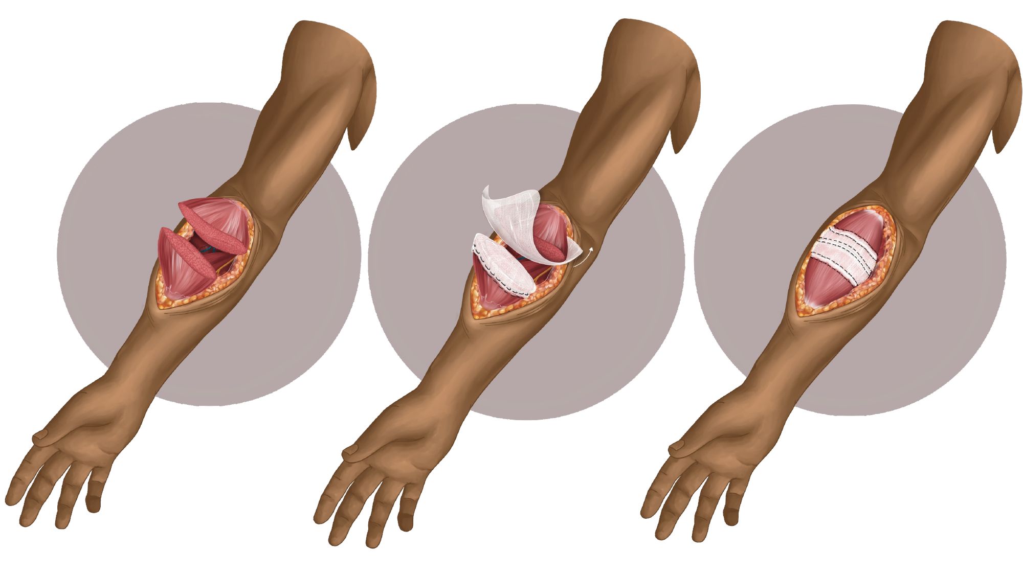 Medical illustration: three stages of the SMART technique applied to a transected forearm muscle.