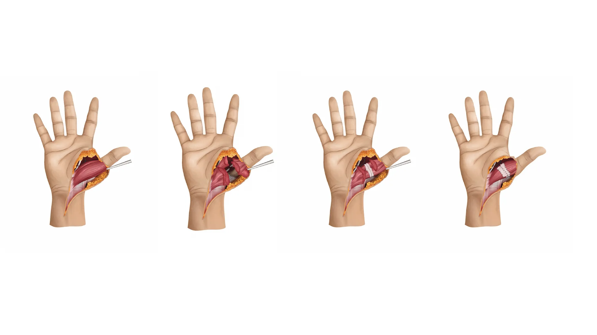 Medical illustration: four stages of the SMART technique applied in the hand.