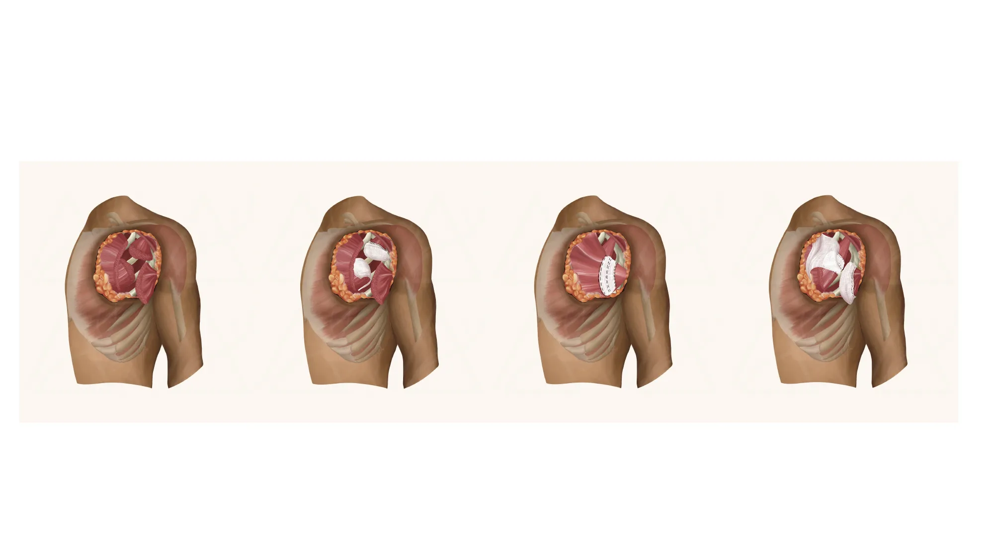 Medical illustration: four stages of the SMART technique applied at the shoulder.